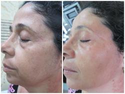 Rejuvenecimiento de piel -  Gam Estetic Laser