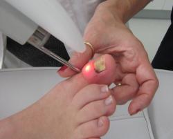 Onicomicosis: Homgos en uñas - Gam Estetic Laser