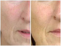 Lifting facial no invasivo - Gam Estetic Laser
